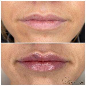 ba lips1 Dr Amy Law Cosmetic Clinic Liverpool