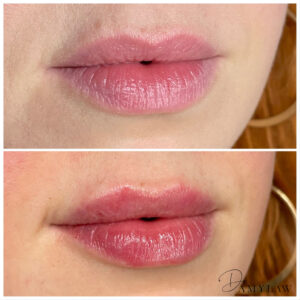 ba lips2 Dr Amy Law Cosmetic Clinic Liverpool