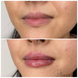 ba lips3 Dr Amy Law Cosmetic Clinic Liverpool