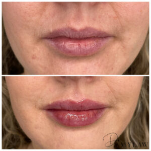 ba lips4 Dr Amy Law Cosmetic Clinic Liverpool