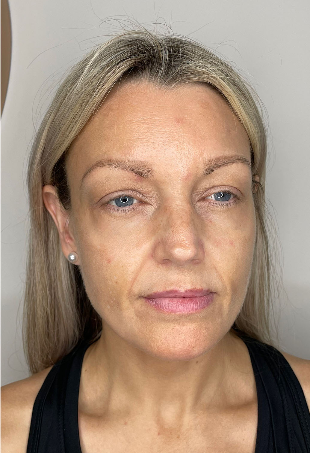 FFrej3b Dr Amy Law Cosmetic Clinic Liverpool