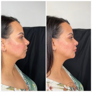 weak chin bf1 Dr Amy Law Cosmetic Clinic Liverpool