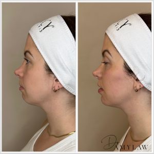 weak chin bf2 Dr Amy Law Cosmetic Clinic Liverpool