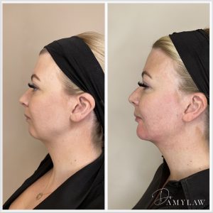 weak chin bf3 Dr Amy Law Cosmetic Clinic Liverpool