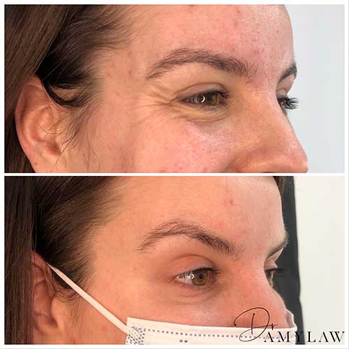 wrinkle 2 Dr Amy Law Cosmetic Clinic Liverpool