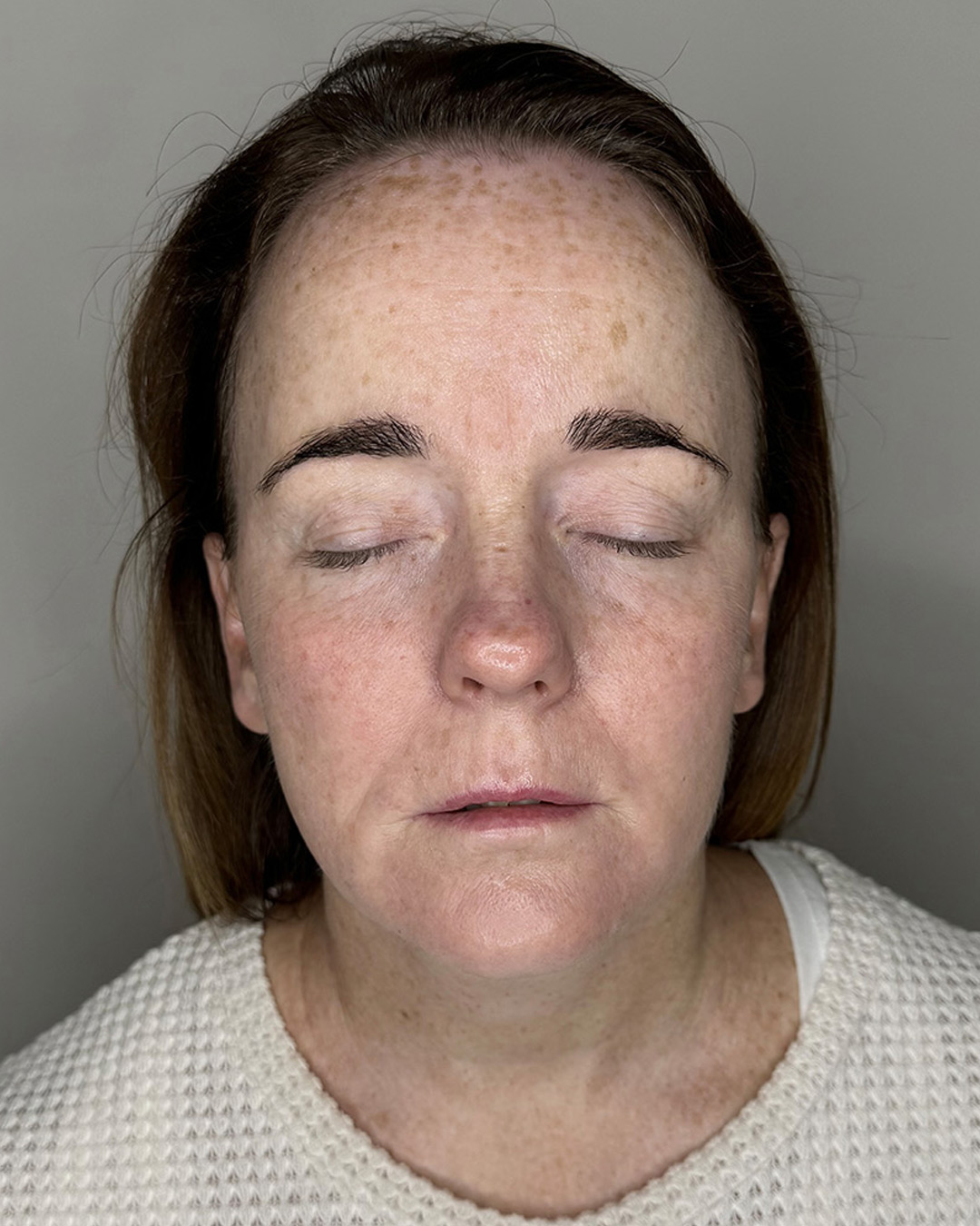 rf12 after Dr Amy Law Cosmetic Clinic Liverpool